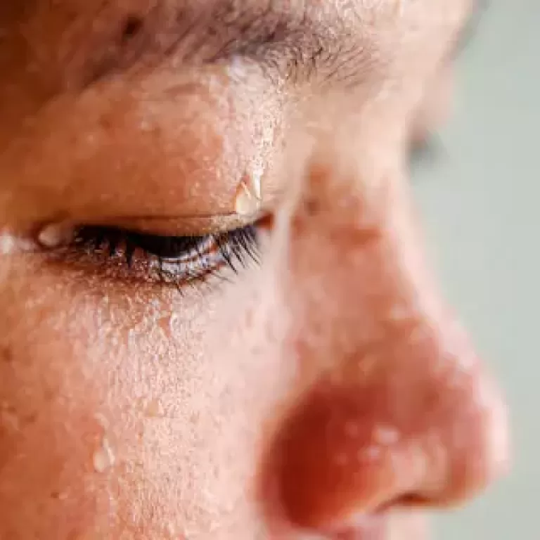 Tratamento da Hiperidrose Facial com Toxina Botulínica